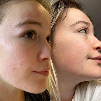 Argan Acne Rehab Serum 30ml | Plant-Based Formula for Acne-Prone Skin