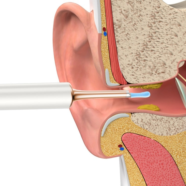 Kit de cure-oreilles intelligent lumineux visible Bebird T15 (blanc aube)